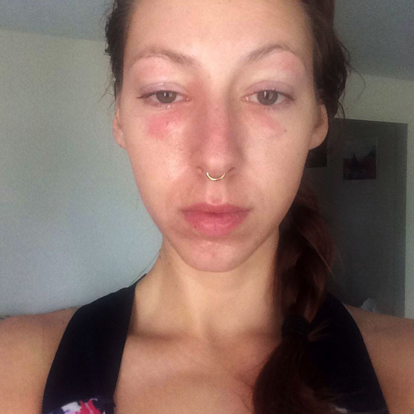 Erica allergic reaction before carnivore diet.