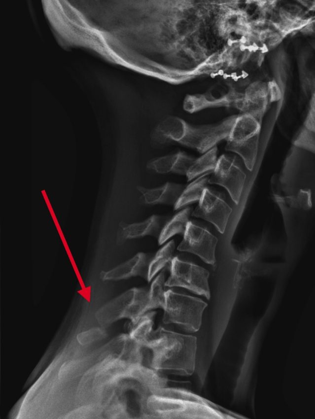 My broken neck radiograph.